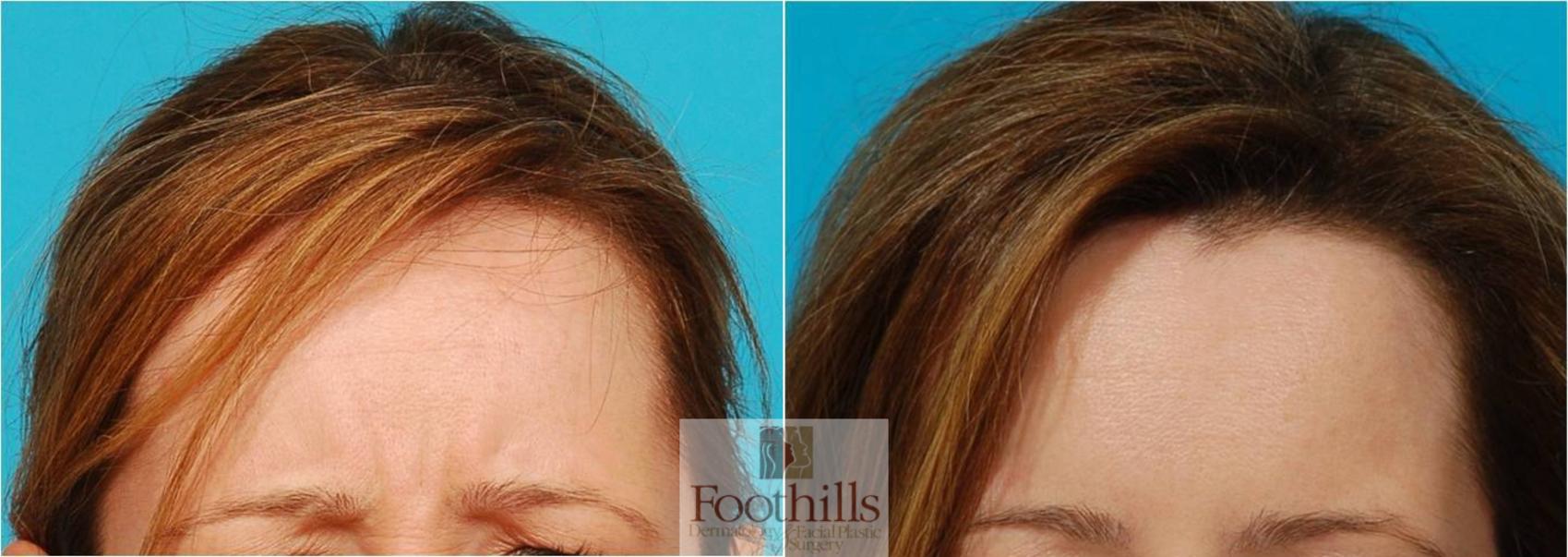BOTOX® Cosmetic Case 59 Before & After View #1 | Tucson, AZ | Foothills Facial Plastic Surgery