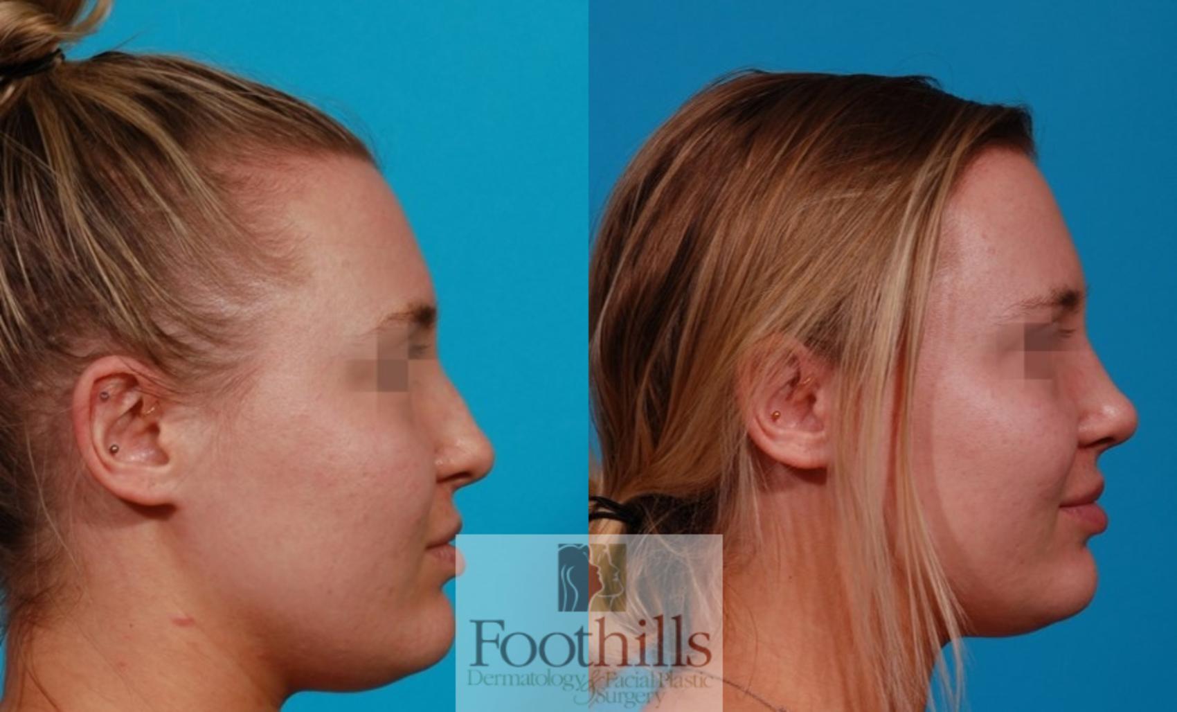 Rhinoplasty