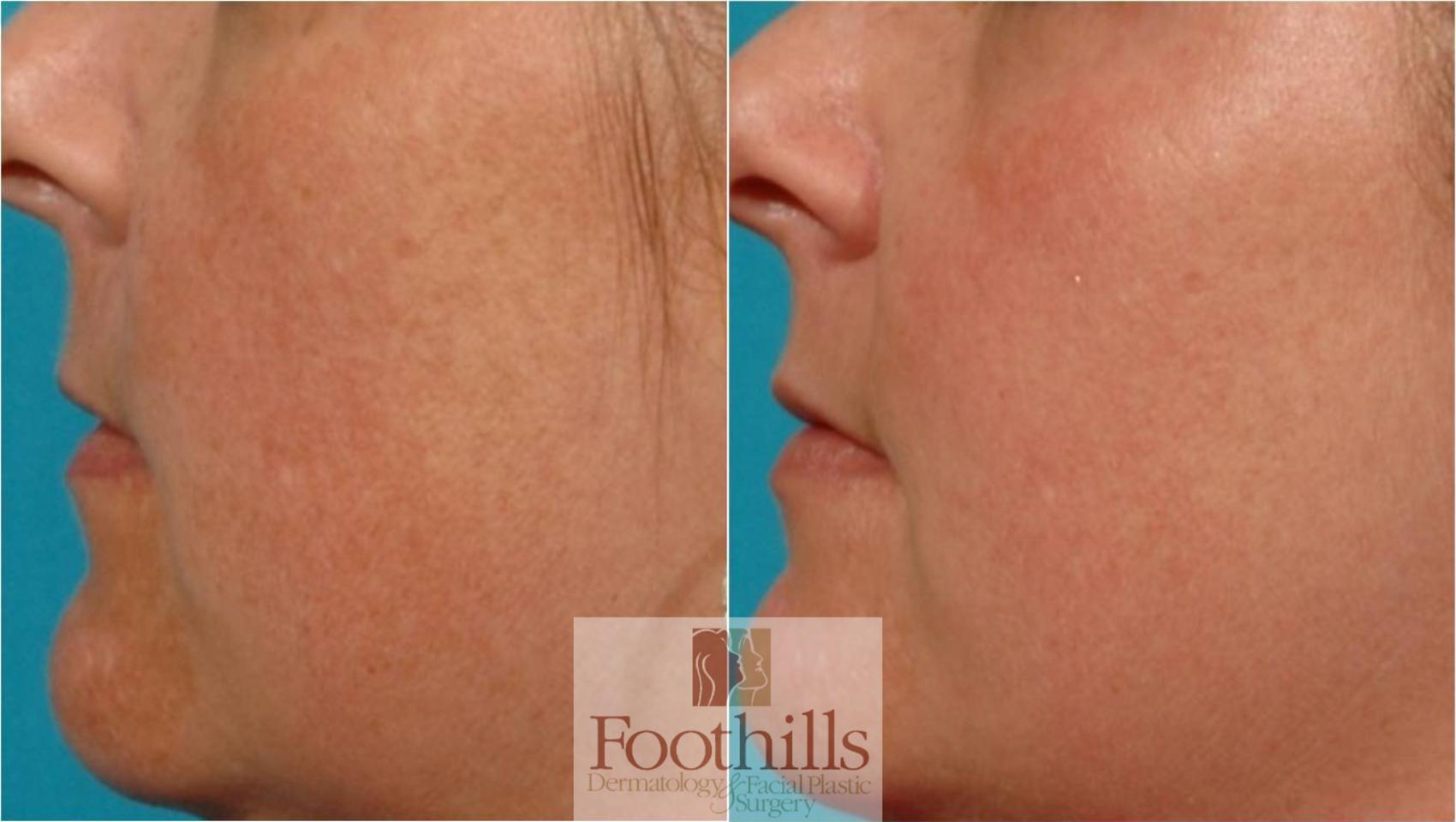 Skin Care Case 28 Before & After View #1 | Tucson, AZ | Foothills Facial Plastic Surgery