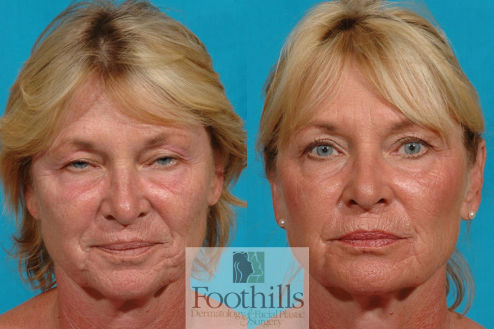 Blepharoplasty (Eyelid Surgery) Case 10 Before & After View #1 | Tucson, AZ | Foothills Facial Plastic Surgery