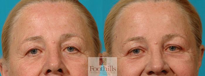 Blepharoplasty (Eyelid Surgery) Case 11 Before & After View #1 | Tucson, AZ | Foothills Facial Plastic Surgery