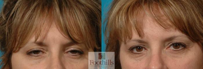 Blepharoplasty (Eyelid Surgery) Case 14 Before & After View #1 | Tucson, AZ | Foothills Facial Plastic Surgery