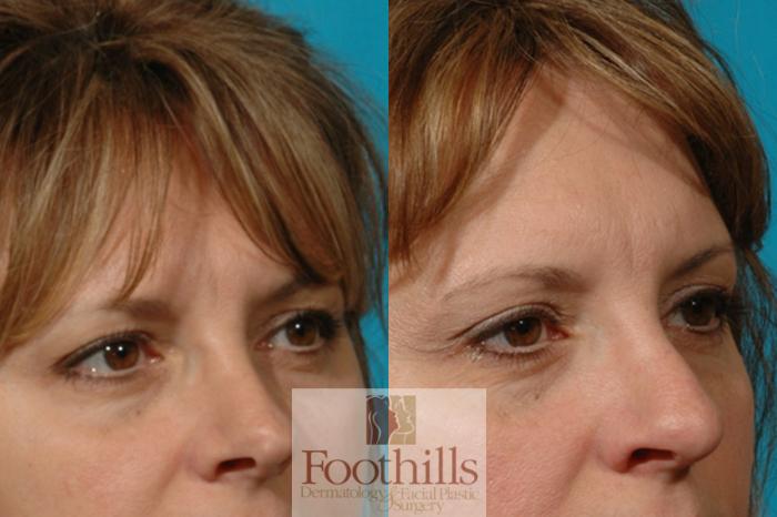 Blepharoplasty (Eyelid Surgery) Case 14 Before & After View #2 | Tucson, AZ | Foothills Facial Plastic Surgery