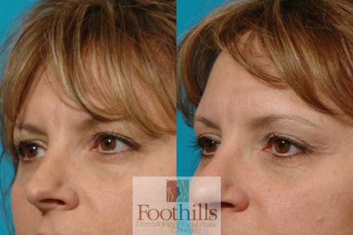 Blepharoplasty (Eyelid Surgery) Case 14 Before & After View #3 | Tucson, AZ | Foothills Facial Plastic Surgery