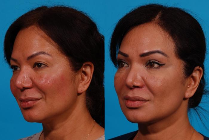 Lip Lift Case 158 Before & After Left Oblique | Tucson, AZ | Foothills Facial Plastic Surgery