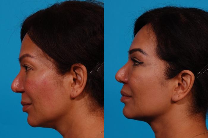 Lip Lift Case 158 Before & After Left Side | Tucson, AZ | Foothills Facial Plastic Surgery