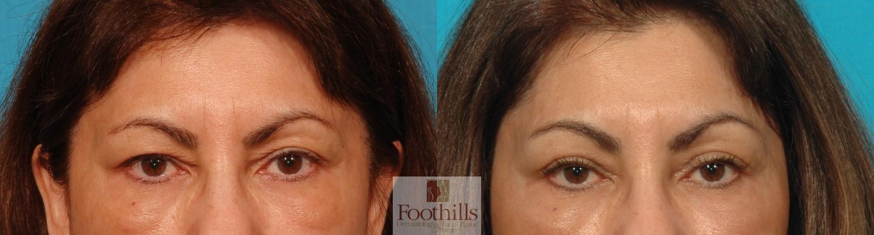 Blepharoplasty (Eyelid Surgery) Case 22 Before & After View #1 | Tucson, AZ | Foothills Facial Plastic Surgery