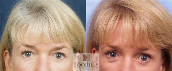 Blepharoplasty (Eyelid Surgery) Case 25 Before & After View #1 | Tucson, AZ | Foothills Facial Plastic Surgery
