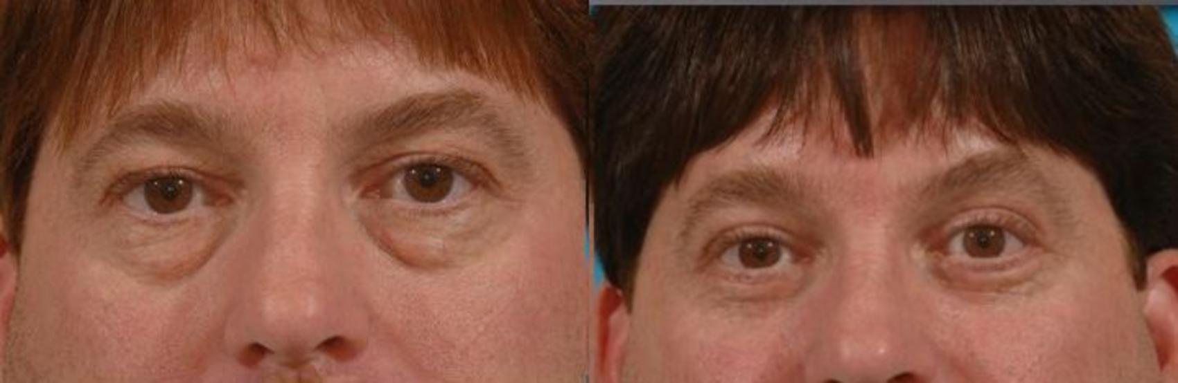 Blepharoplasty (Eyelid Surgery) Case 71 Before & After View #1 | Tucson, AZ | Foothills Facial Plastic Surgery