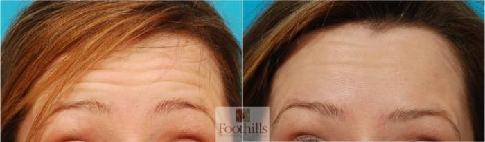 BOTOX® Cosmetic Case 59 Before & After View #2 | Tucson, AZ | Foothills Facial Plastic Surgery
