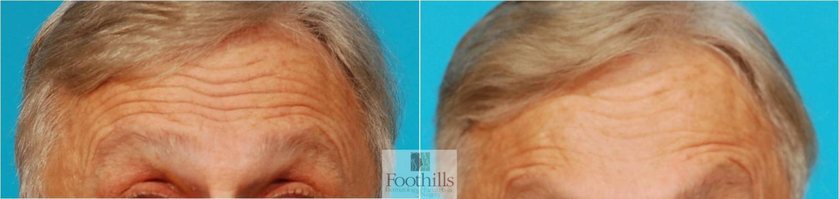 BOTOX® Cosmetic Case 61 Before & After View #1 | Tucson, AZ | Foothills Facial Plastic Surgery