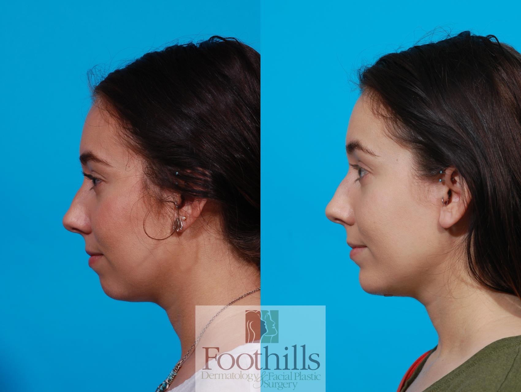 Chin Augmentation Case 100 Before & After View #1 | Tucson, AZ | Foothills Facial Plastic Surgery