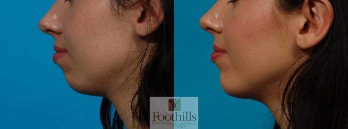 Chin Augmentation Case 115 Before & After View #1 | Tucson, AZ | Foothills Facial Plastic Surgery