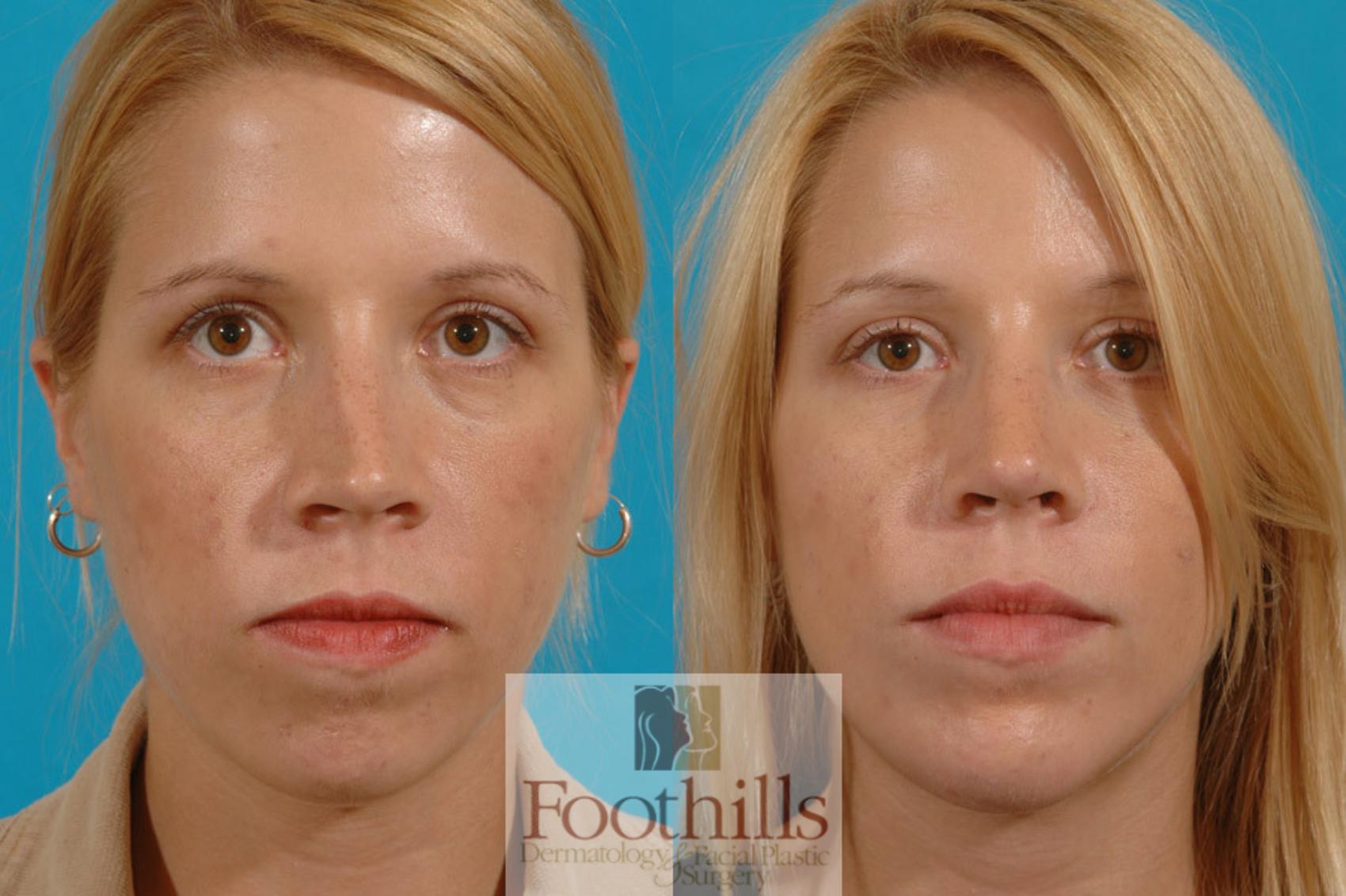 Chin Augmentation Case 7 Before & After View #1 | Tucson, AZ | Foothills Facial Plastic Surgery