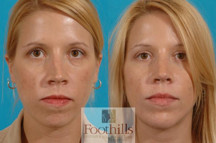 Chin Augmentation Case 7 Before & After View #1 | Tucson, AZ | Foothills Facial Plastic Surgery