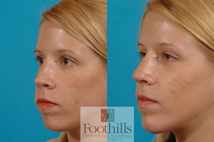Rhinoplasty Case 7 Before & After View #2 | Tucson, AZ | Foothills Facial Plastic Surgery