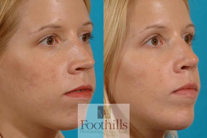 Chin Augmentation Case 7 Before & After View #3 | Tucson, AZ | Foothills Facial Plastic Surgery