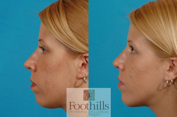 Rhinoplasty Case 7 Before & After View #4 | Tucson, AZ | Foothills Facial Plastic Surgery