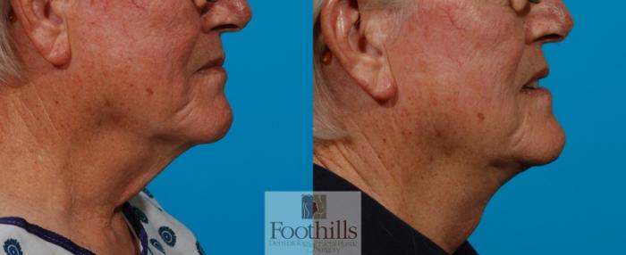 Direct Neck Lift Case 101 Before & After View #1 | Tucson, AZ | Foothills Facial Plastic Surgery