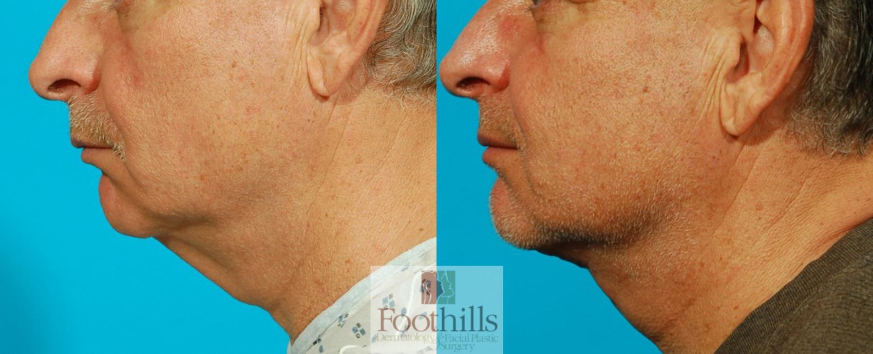 Direct Neck Lift Case 103 Before & After View #1 | Tucson, AZ | Foothills Facial Plastic Surgery