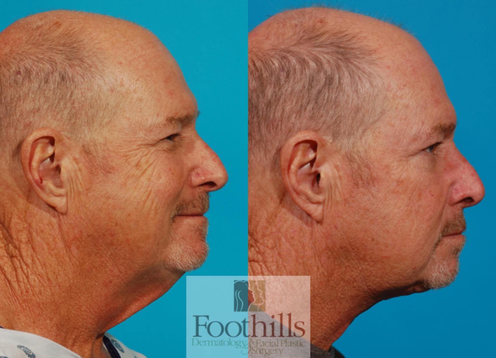 Direct Neck Lift Case 131 Before & After View #1 | Tucson, AZ | Foothills Facial Plastic Surgery