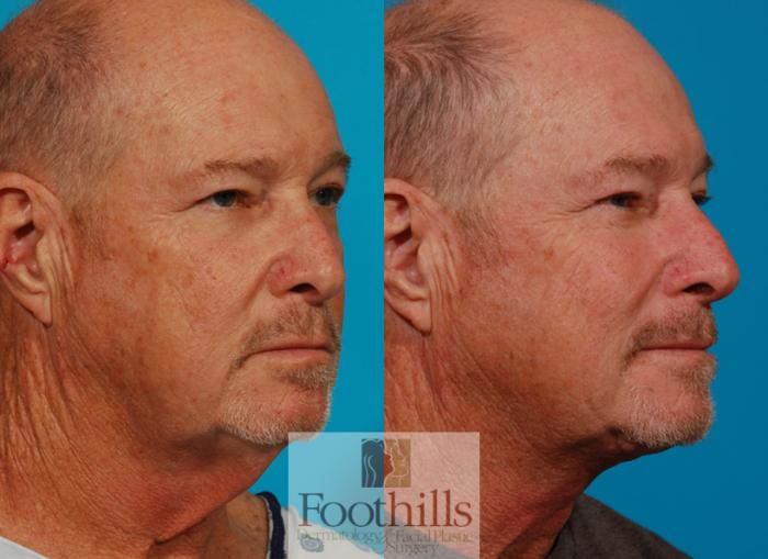 Direct Neck Lift Case 131 Before & After View #2 | Tucson, AZ | Foothills Facial Plastic Surgery