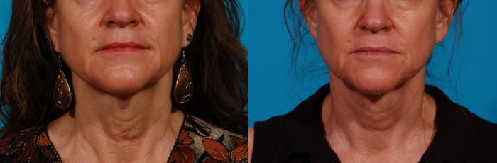 Direct Neck Lift Case 176 Before & After Front | Tucson, AZ | Foothills Facial Plastic Surgery