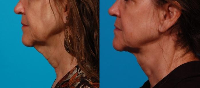 Direct Neck Lift Case 176 Before & After Left Side | Tucson, AZ | Foothills Facial Plastic Surgery