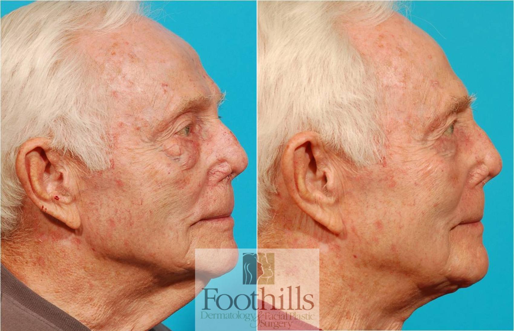 Direct Neck Lift Case 44 Before & After View #1 | Tucson, AZ | Foothills Facial Plastic Surgery