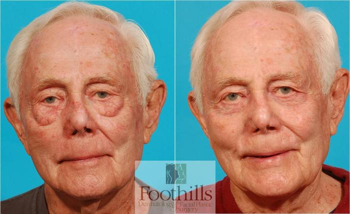 Direct Neck Lift Case 44 Before & After View #2 | Tucson, AZ | Foothills Facial Plastic Surgery