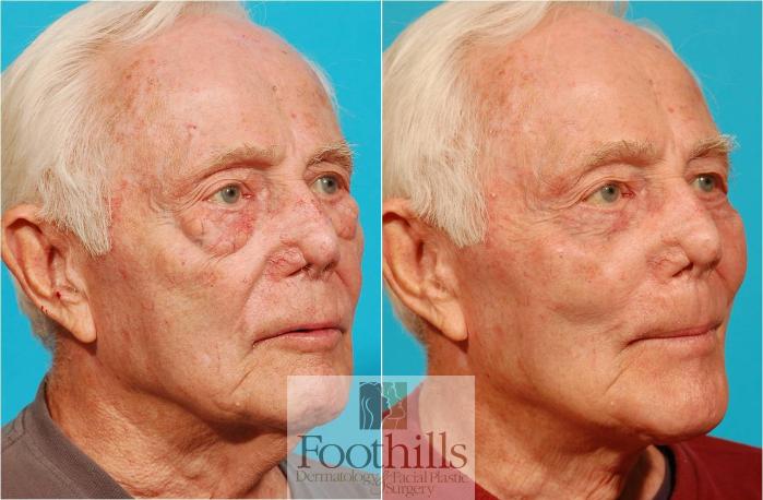 Direct Neck Lift Case 44 Before & After View #3 | Tucson, AZ | Foothills Facial Plastic Surgery
