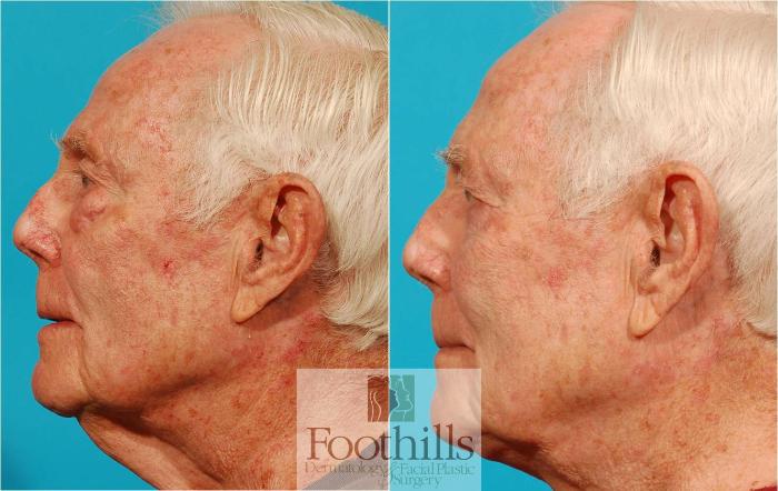 Blepharoplasty (Eyelid Surgery) Case 44 Before & After View #4 | Tucson, AZ | Foothills Facial Plastic Surgery