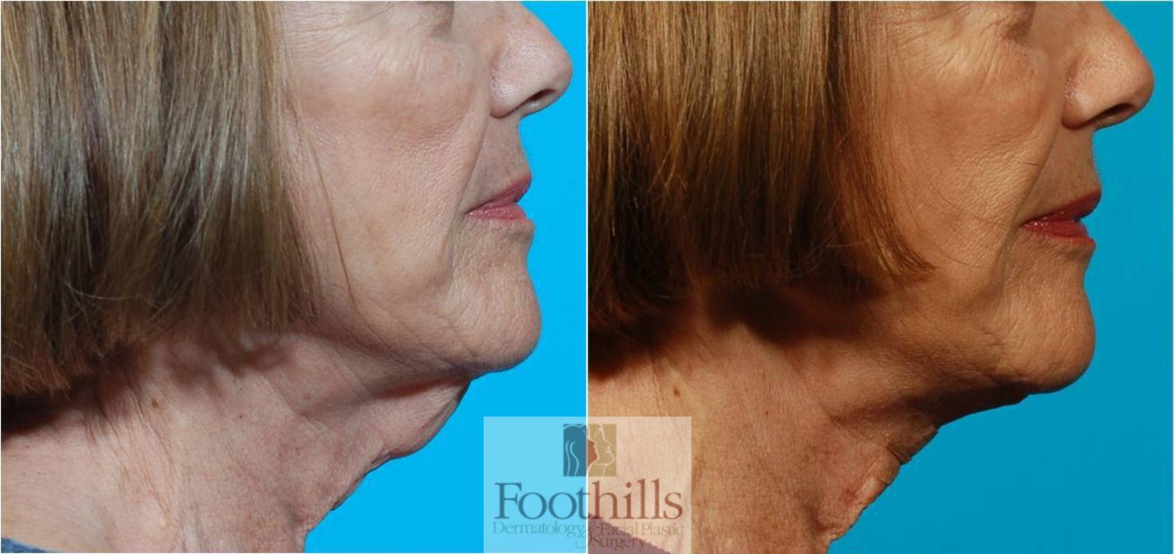 Direct Neck Lift Before & After Photos Patient 45 | Tucson, AZ ...