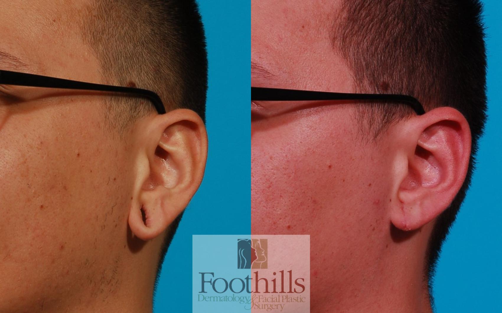 Ear Gauge Repair Case 123 Before & After View #1 | Tucson, AZ | Foothills Facial Plastic Surgery