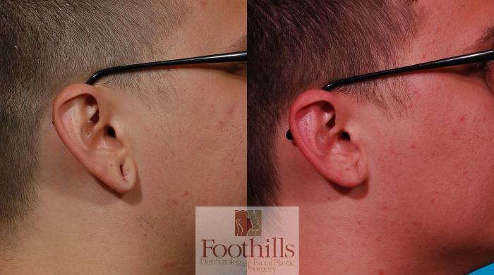 Ear Gauge Repair Case 123 Before & After View #2 | Tucson, AZ | Foothills Facial Plastic Surgery