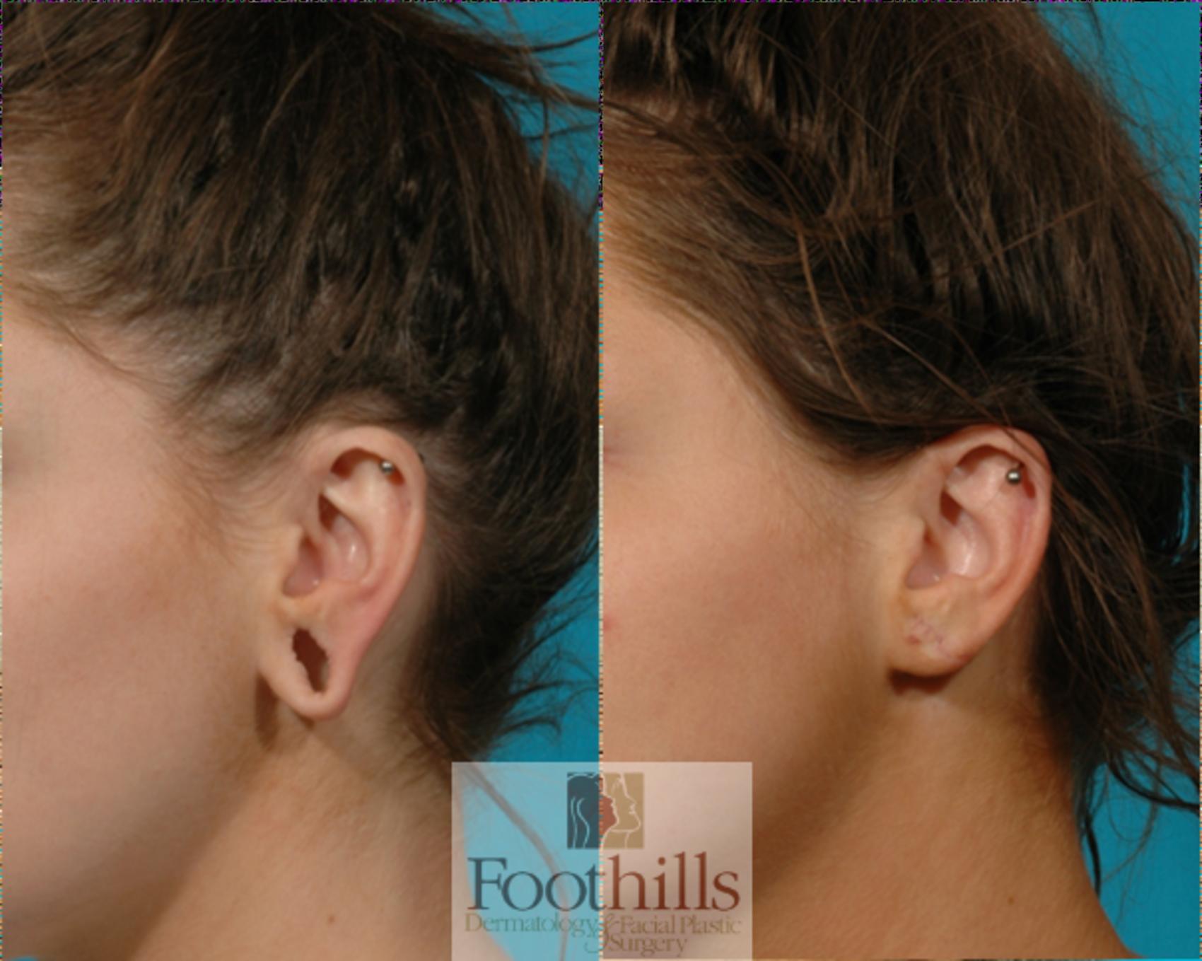 Ear Gauge Repair Case 65 Before & After View #1 | Tucson, AZ | Foothills Facial Plastic Surgery