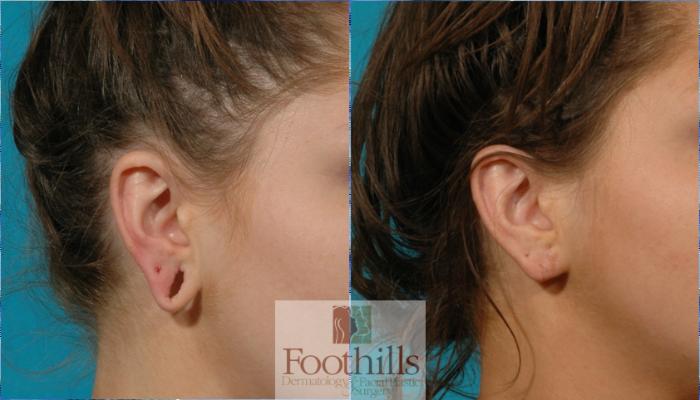 Ear Gauge Repair Case 65 Before & After View #2 | Tucson, AZ | Foothills Facial Plastic Surgery