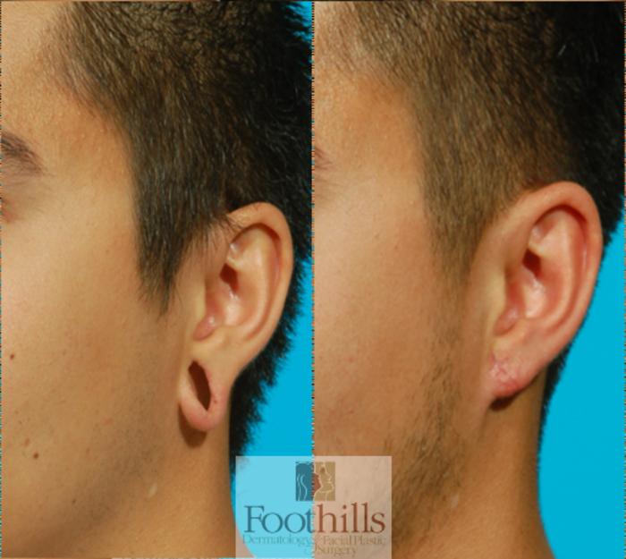 Ear Gauge Repair Case 66 Before & After View #2 | Tucson, AZ | Foothills Facial Plastic Surgery