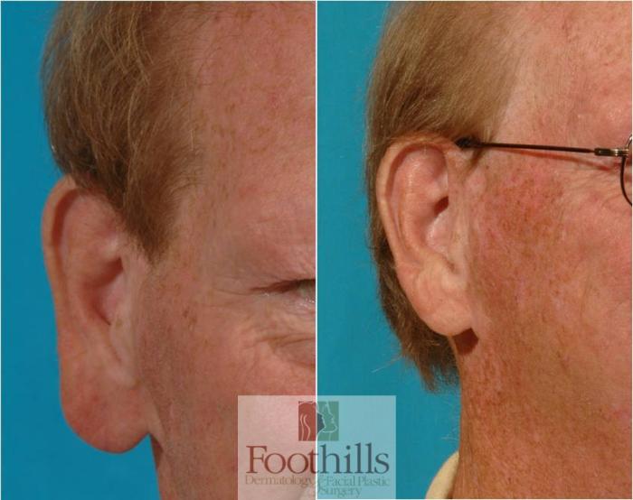 Ear Lobe Reduction Case 46 Before & After View #1 | Tucson, AZ | Foothills Facial Plastic Surgery