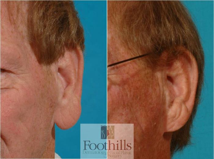 Ear Lobe Reduction Case 46 Before & After View #2 | Tucson, AZ | Foothills Facial Plastic Surgery