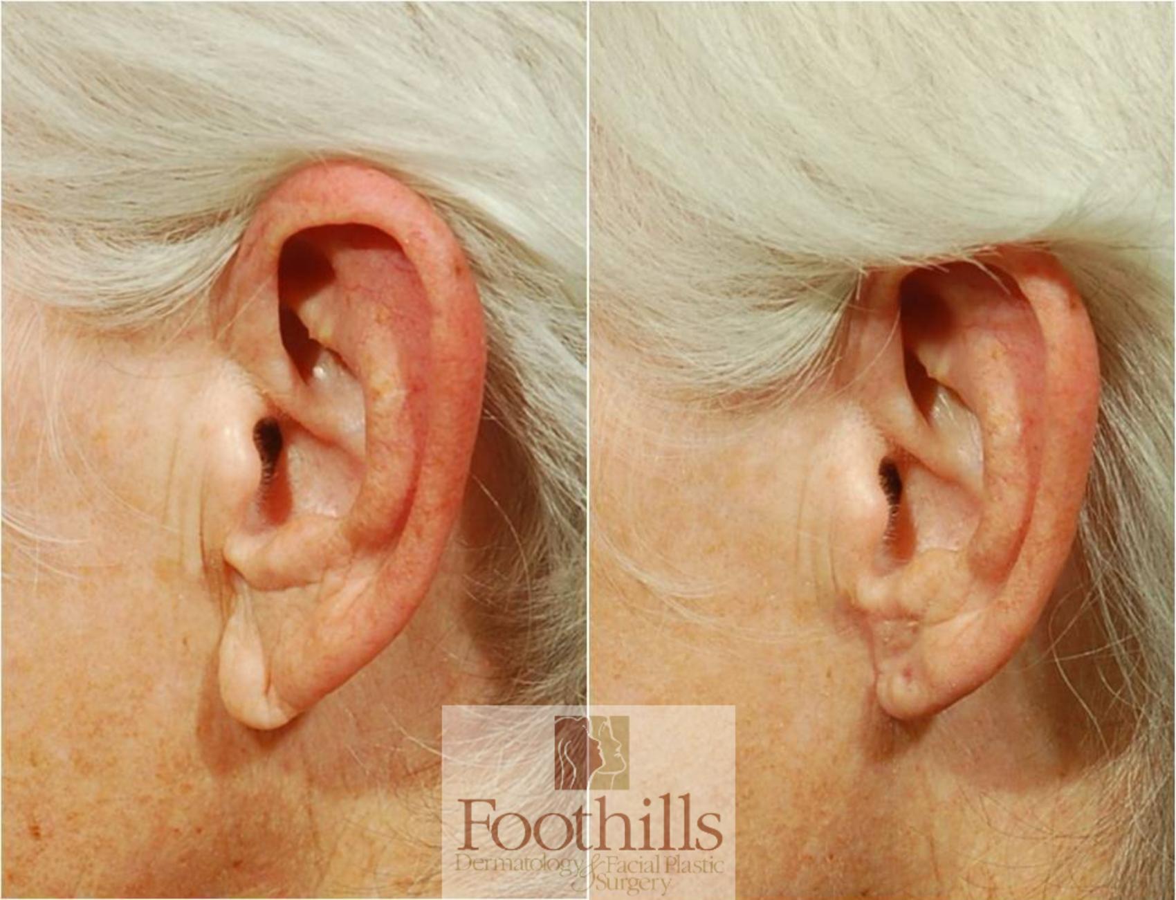 Ear Lobe Reduction Case 63 Before & After View #1 | Tucson, AZ | Foothills Facial Plastic Surgery