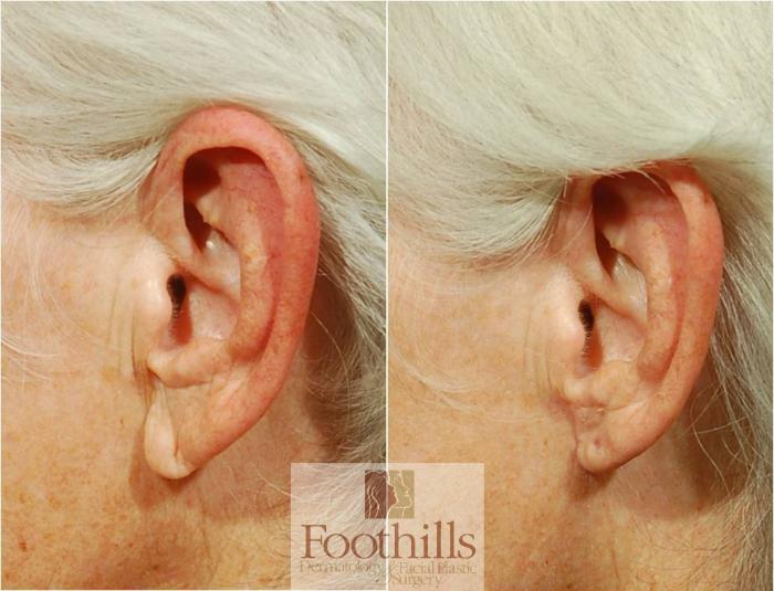 Ear Lobe Reduction Case 63 Before & After View #1 | Tucson, AZ | Foothills Facial Plastic Surgery