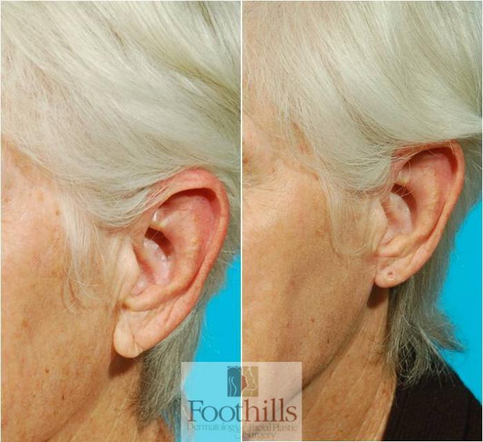 Ear Lobe Reduction Case 63 Before & After View #2 | Tucson, AZ | Foothills Facial Plastic Surgery