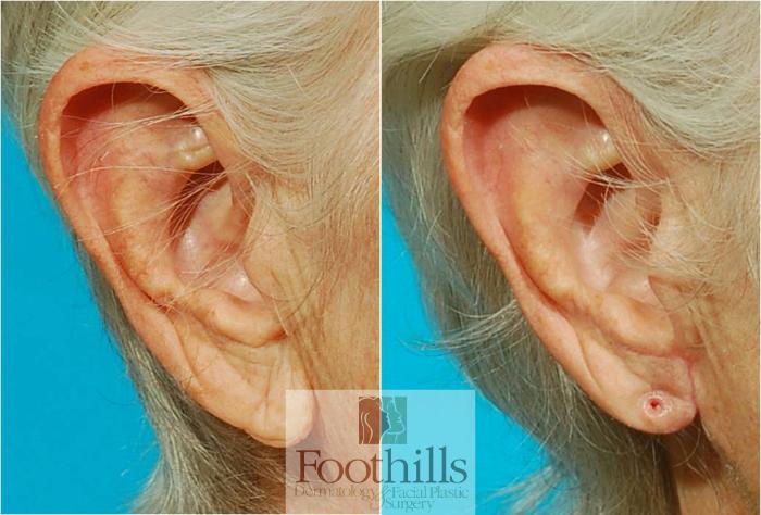 Ear Lobe Reduction Case 63 Before & After View #3 | Tucson, AZ | Foothills Facial Plastic Surgery