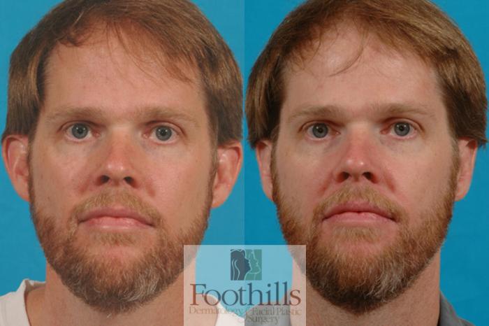 Ear Surgery (Otoplasty) Case 17 Before & After View #1 | Tucson, AZ | Foothills Facial Plastic Surgery