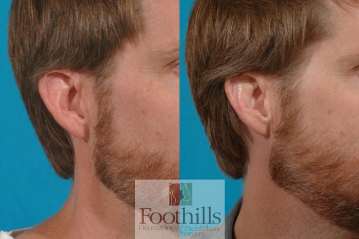 Ear Surgery (Otoplasty) Case 17 Before & After View #2 | Tucson, AZ | Foothills Facial Plastic Surgery