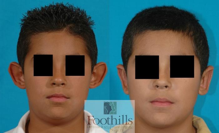 Ear Surgery (Otoplasty) Case 79 Before & After View #1 | Tucson, AZ | Foothills Facial Plastic Surgery