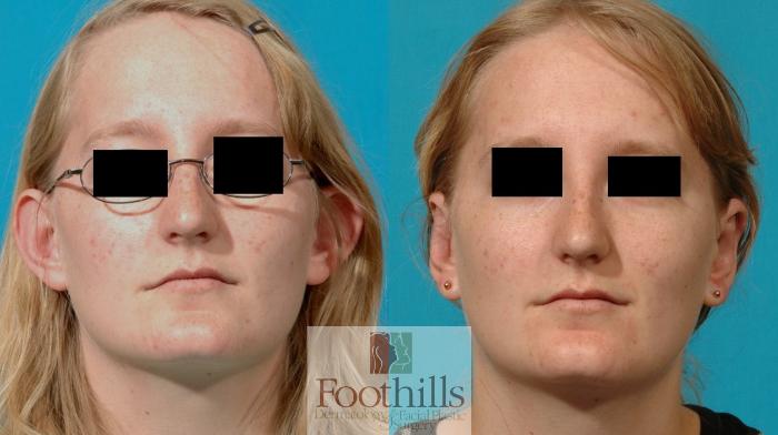 Ear Surgery (Otoplasty) Case 81 Before & After View #1 | Tucson, AZ | Foothills Facial Plastic Surgery