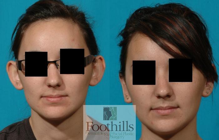 Ear Surgery (Otoplasty) Case 82 Before & After View #1 | Tucson, AZ | Foothills Facial Plastic Surgery