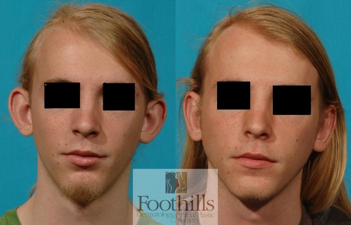Ear Surgery (Otoplasty) Case 83 Before & After View #1 | Tucson, AZ | Foothills Facial Plastic Surgery